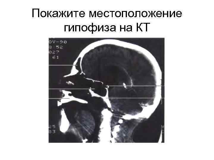 Покажите местоположение гипофиза на КТ 