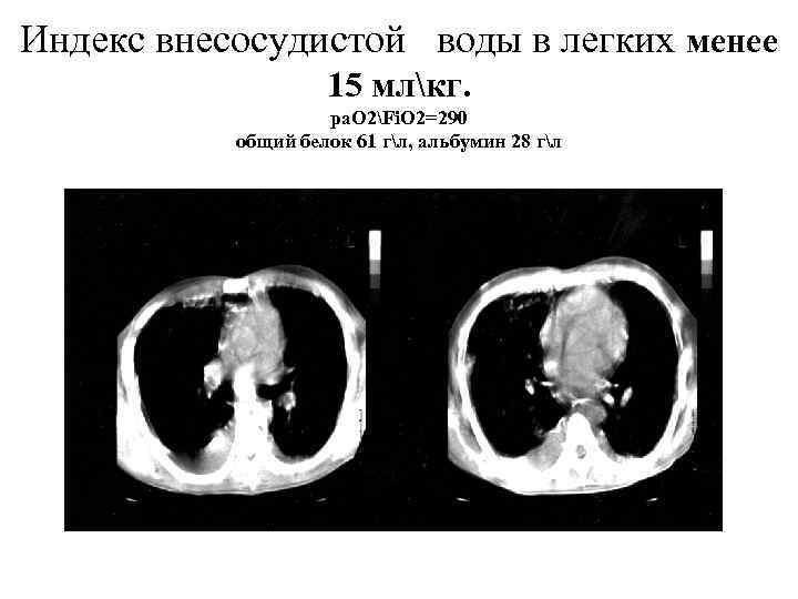 Индекс внесосудистой  воды в легких менее    15 млкг.  