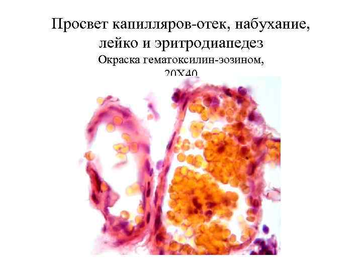 Просвет капилляров-отек, набухание,   лейко и эритродиапедез  Окраска гематоксилин-эозином,   