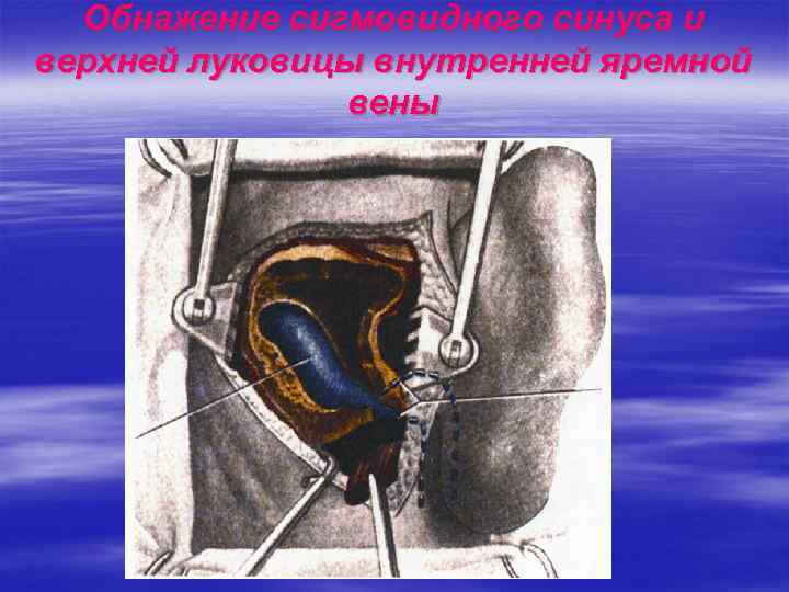  Обнажение сигмовидного синуса и верхней луковицы внутренней яремной    вены 