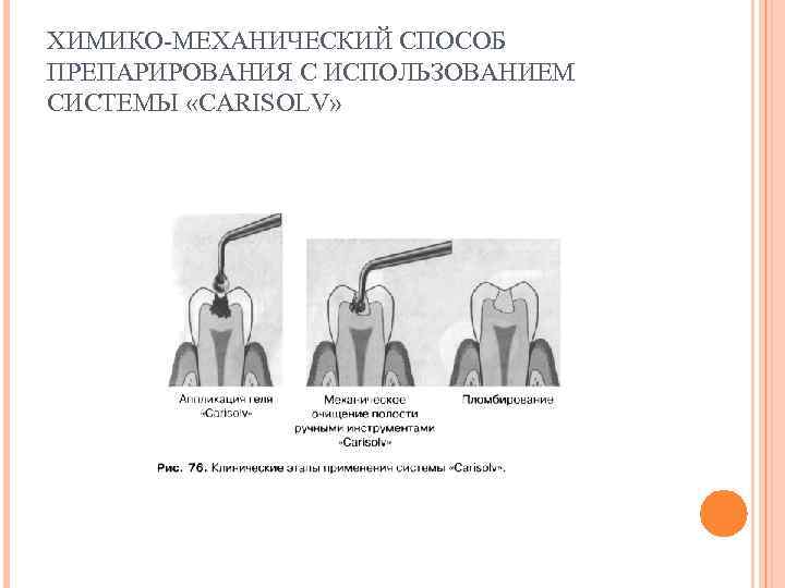 ХИМИКО-МЕХАНИЧЕСКИЙ СПОСОБ ПРЕПАРИРОВАНИЯ С ИСПОЛЬЗОВАНИЕМ СИСТЕМЫ «CARISOLV» 