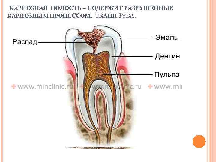 КАРИОЗНАЯ ПОЛОСТЬ – СОДЕРЖИТ РАЗРУШЕННЫЕ КАРИОЗНЫМ ПРОЦЕССОМ, ТКАНИ ЗУБА. 