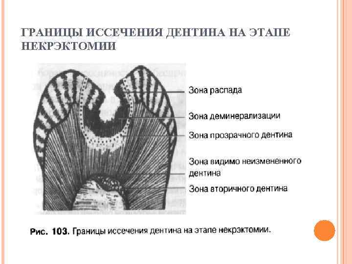 ГРАНИЦЫ ИССЕЧЕНИЯ ДЕНТИНА НА ЭТАПЕ НЕКРЭКТОМИИ 