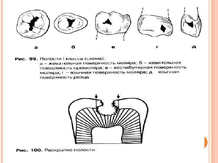 КАРИОЗНЫЕ ПОЛОСТИ I КЛАССА 