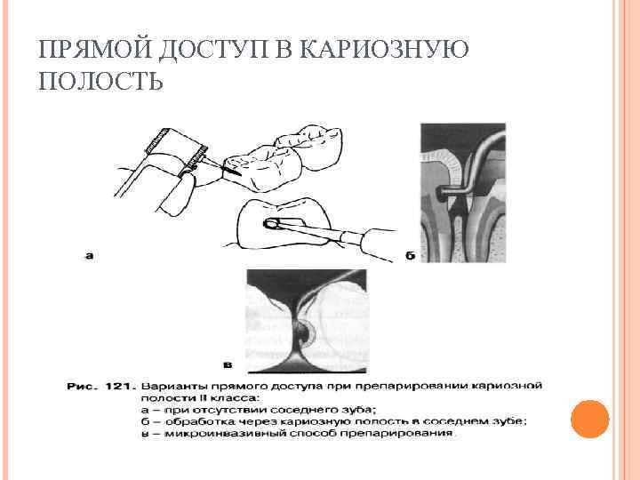 ПРЯМОЙ ДОСТУП В КАРИОЗНУЮ ПОЛОСТЬ 