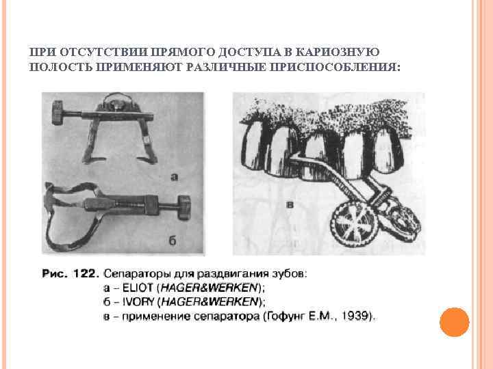 ПРИ ОТСУТСТВИИ ПРЯМОГО ДОСТУПА В КАРИОЗНУЮ ПОЛОСТЬ ПРИМЕНЯЮТ РАЗЛИЧНЫЕ ПРИСПОСОБЛЕНИЯ: 