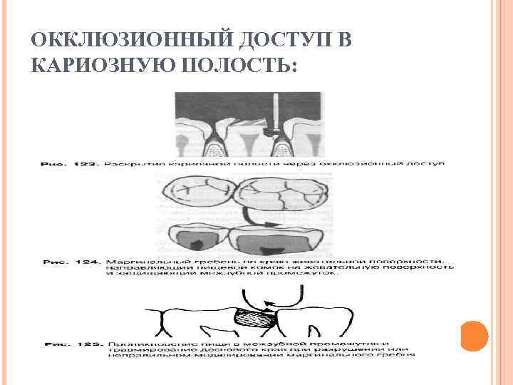 ОККЛЮЗИОННЫЙ ДОСТУП В КАРИОЗНУЮ ПОЛОСТЬ: 