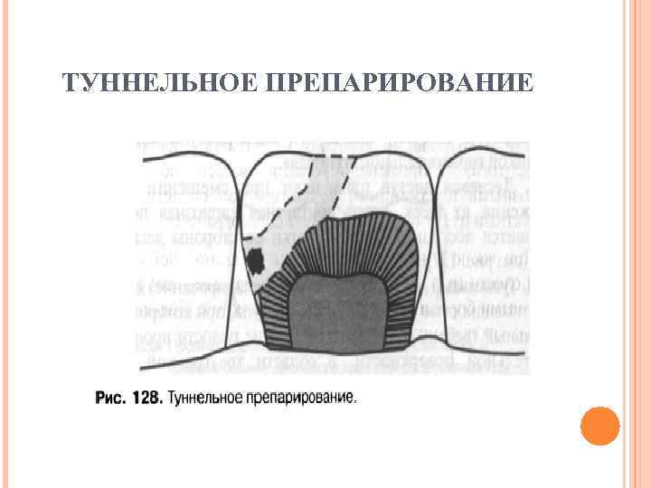 ТУННЕЛЬНОЕ ПРЕПАРИРОВАНИЕ 