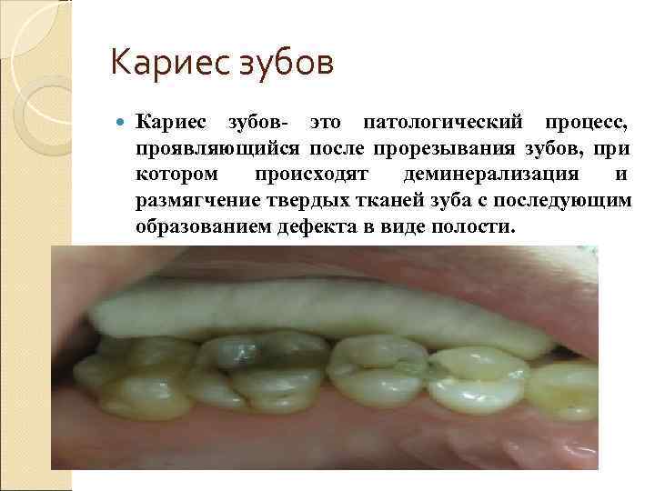 Кариес зубов- это патологический процесс, проявляющийся после прорезывания зубов, при котором  происходят 