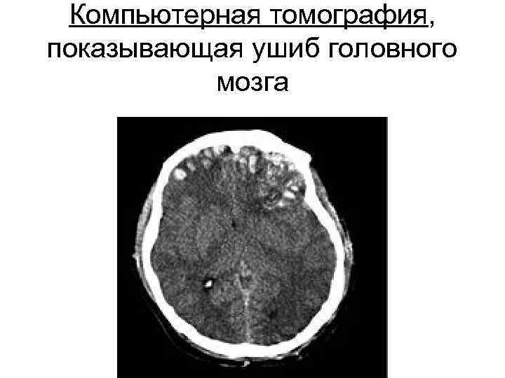  Компьютерная томография,  показывающая ушиб головного  мозга 