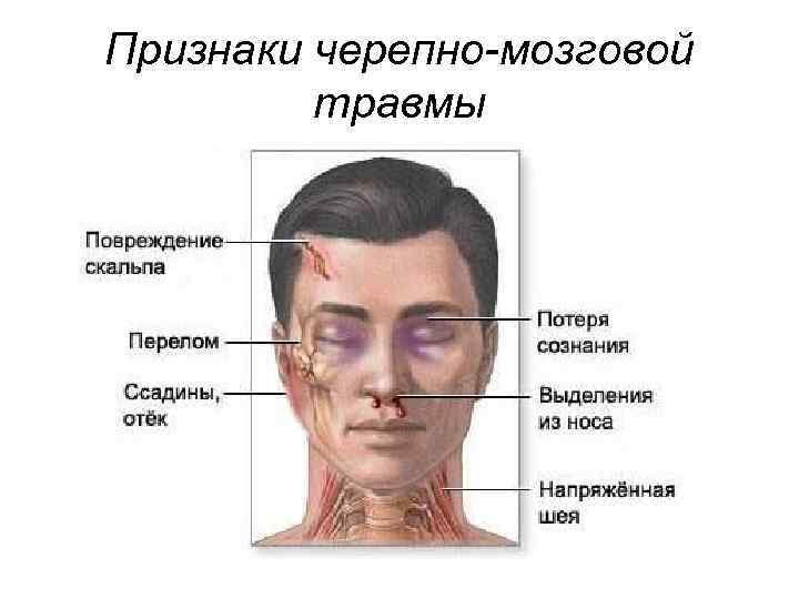 Признаки черепно-мозговой  травмы 