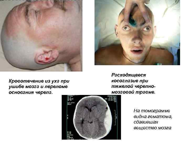       Расходящееся Кровотечение из уха при  косоглазие при