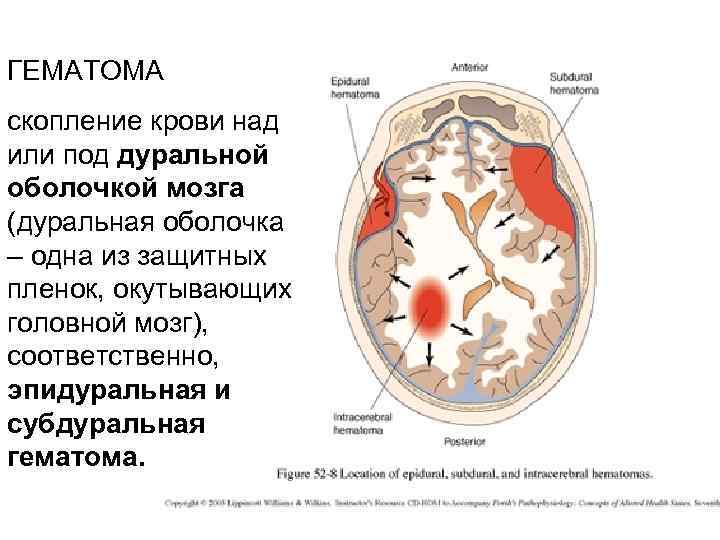 ГЕМАТОМА скопление крови над или под дуральной оболочкой мозга (дуральная оболочка – одна из