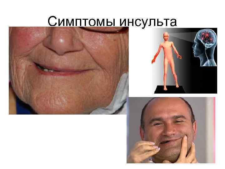 Симптомы инсульта 