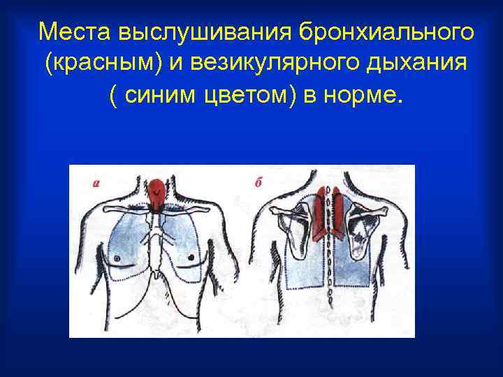 Места выслушивания бронхиального (красным) и везикулярного дыхания ( синим цветом) в норме. 