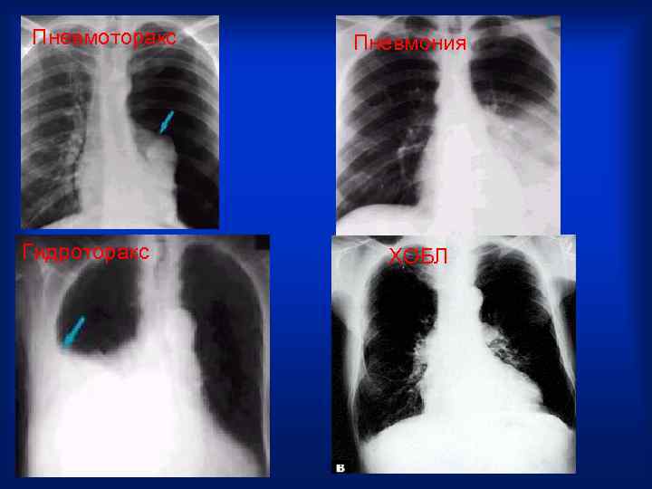 Пневмоторакс  Пневмония Гидроторакс ХОБЛ 