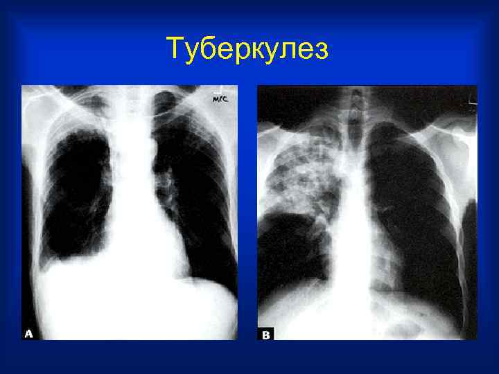 Туберкулез 