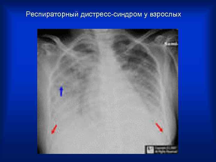 Респираторный дистресс-синдром у взрослых 