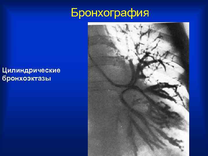    Бронхография  Цилиндрические бронхоэктазы 