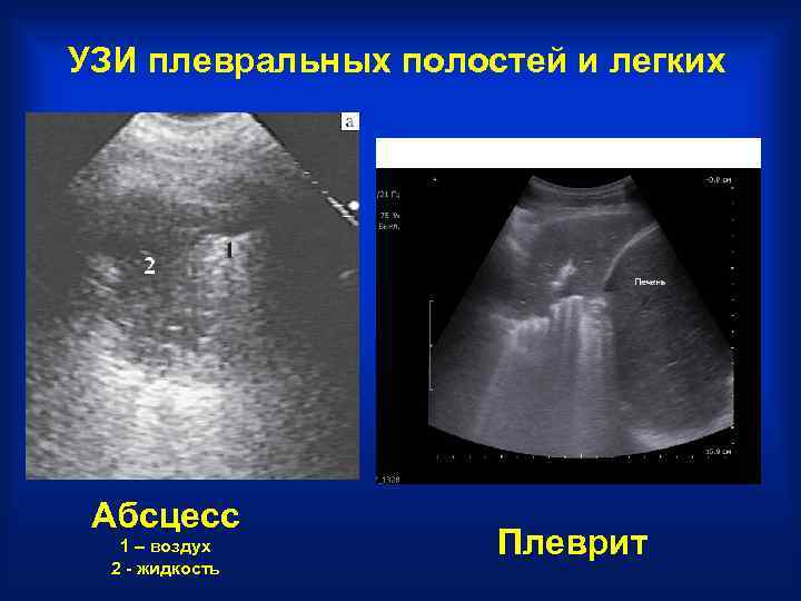 Жидкость в плевральной полости на узи фото