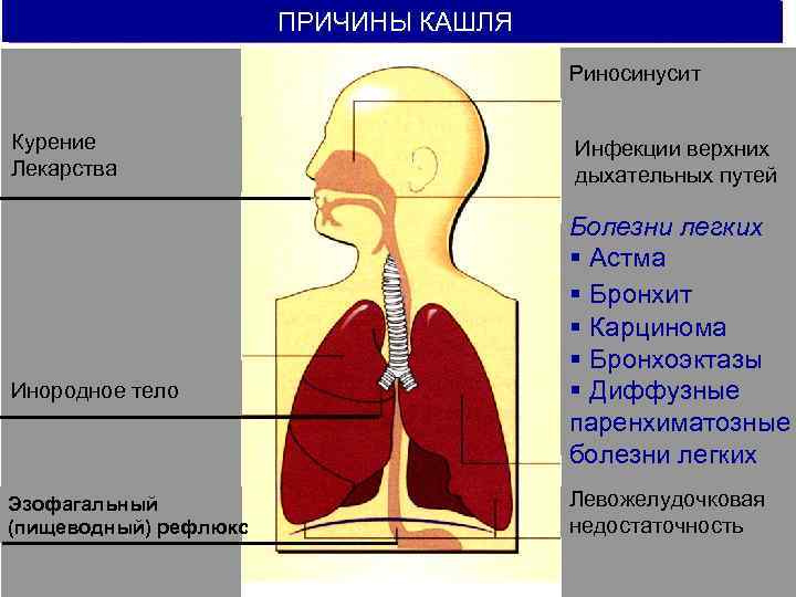     ПРИЧИНЫ КАШЛЯ    Риносинусит  Курение  