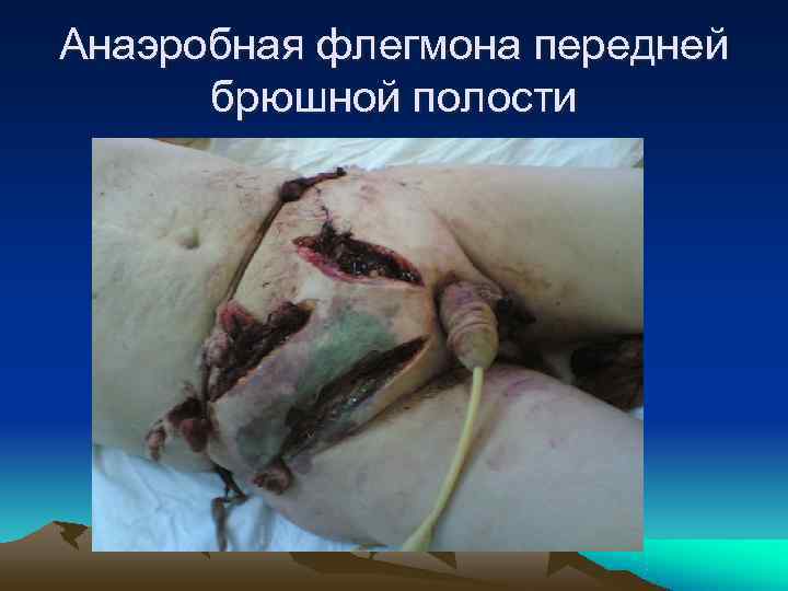 Анаэробная флегмона передней  брюшной полости 