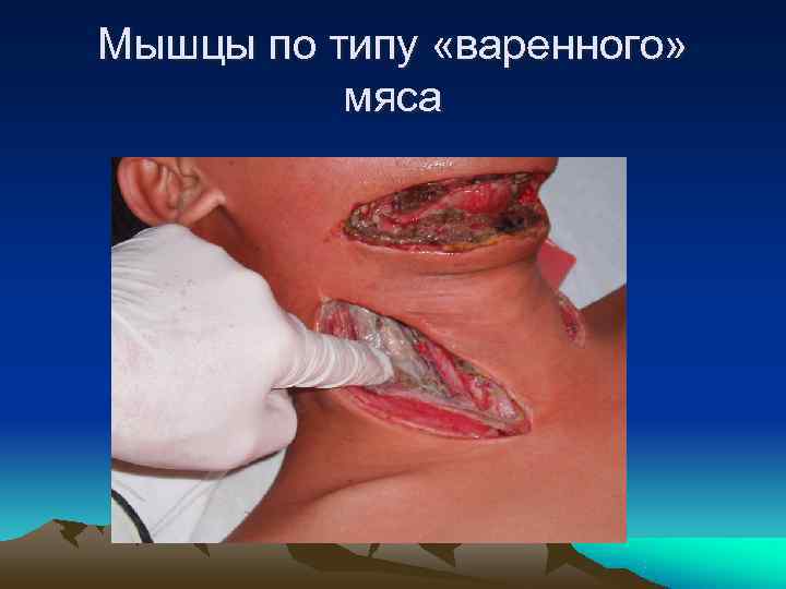 Мышцы по типу «варенного»  мяса 