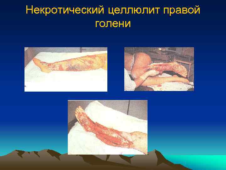 Некротический целлюлит правой   голени 