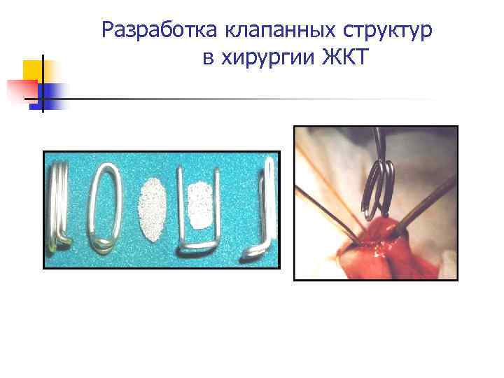 Разработка клапанных структур   в хирургии ЖКТ 