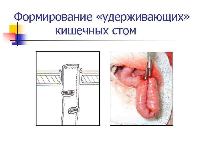 Формирование «удерживающих»  кишечных стом 