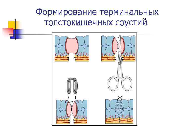 Формирование терминальных толстокишечных соустий 