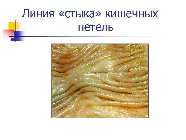 Линия «стыка» кишечных   петель 