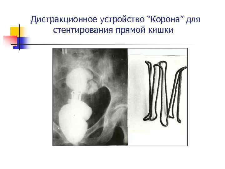 Дистракционное устройство “Корона” для стентирования прямой кишки 