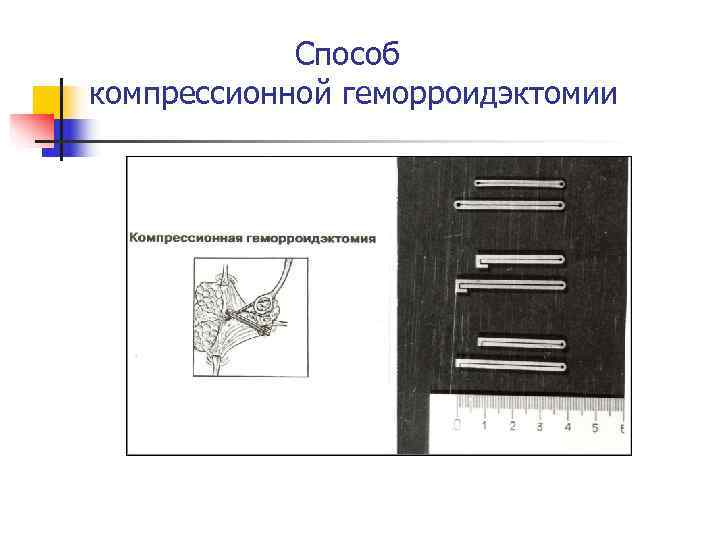   Способ компрессионной геморроидэктомии 