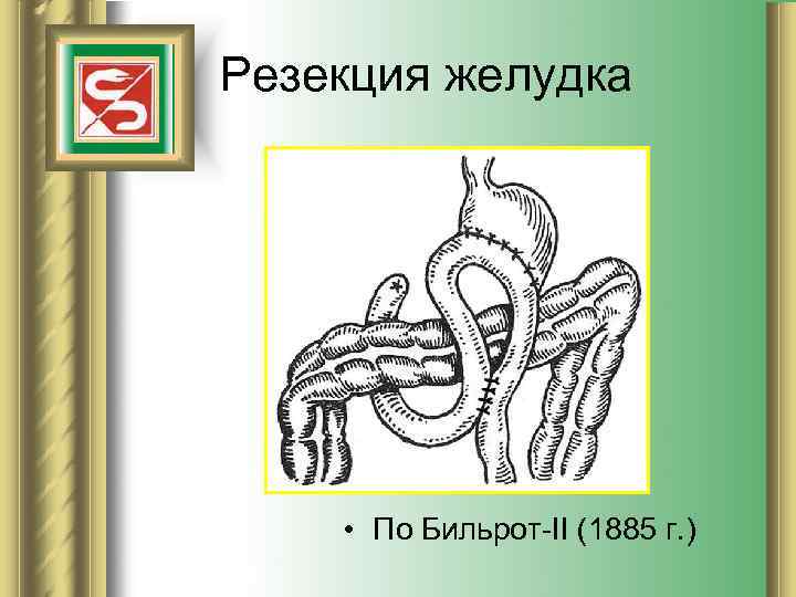 Резекция желудка   • По Бильрот-II (1885 г. ) 