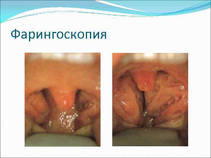 Фарингоскопия 
