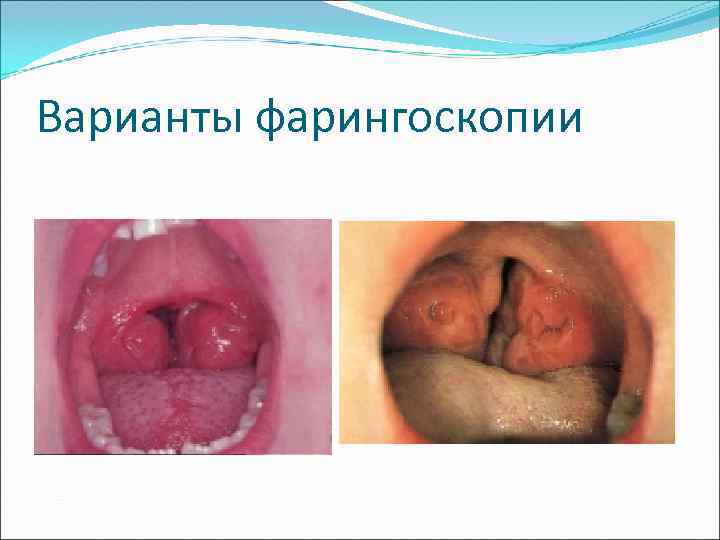 Варианты фарингоскопии 