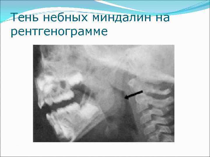 Тень небных миндалин на рентгенограмме 