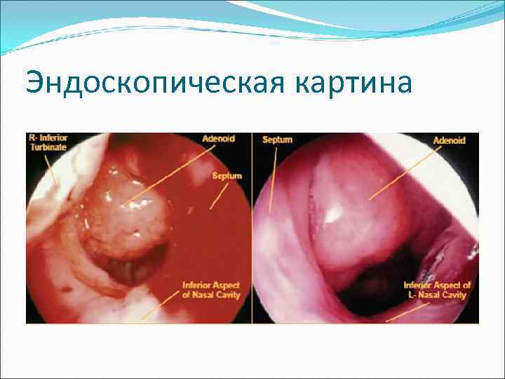 Эндоскопическая картина 