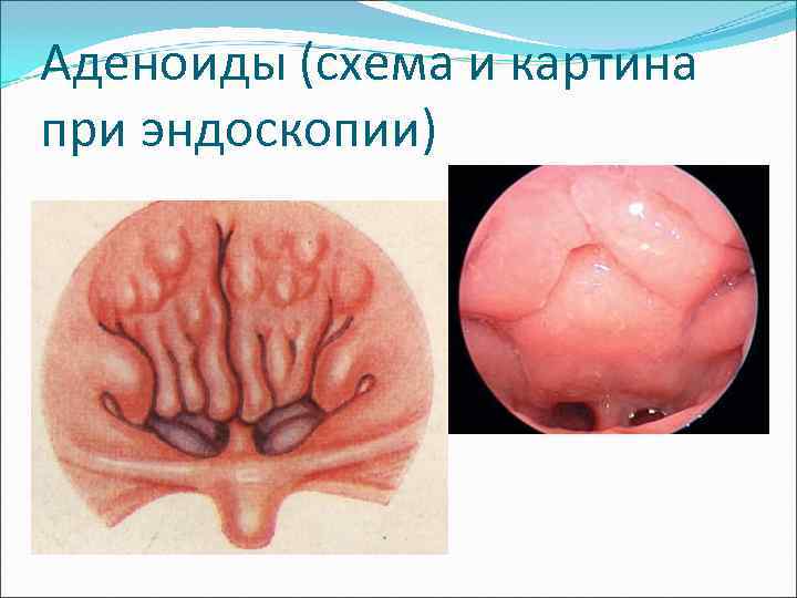 Аденоиды (схема и картина при эндоскопии) 