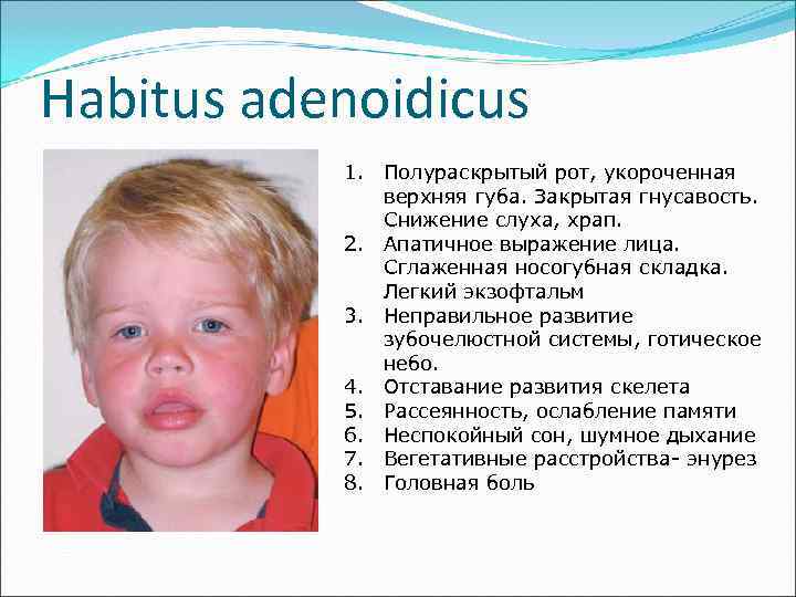 Habitus adenoidicus  1. Полураскрытый рот, укороченная    верхняя губа. Закрытая гнусавость.