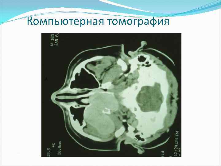 Компьютерная томография 