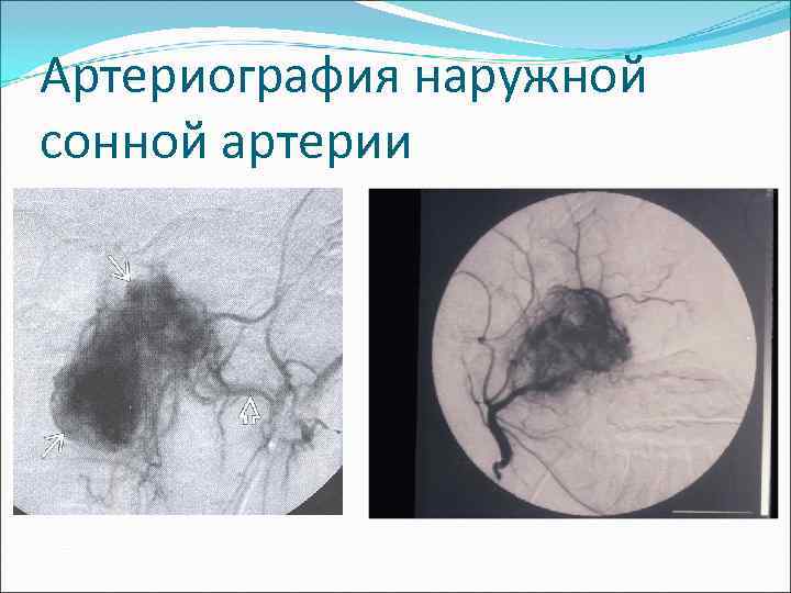 Артериография наружной сонной артерии 