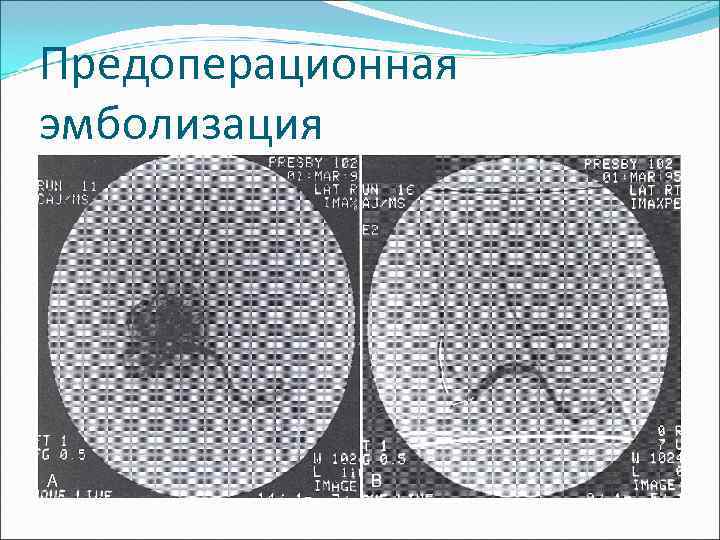 Предоперационная эмболизация 