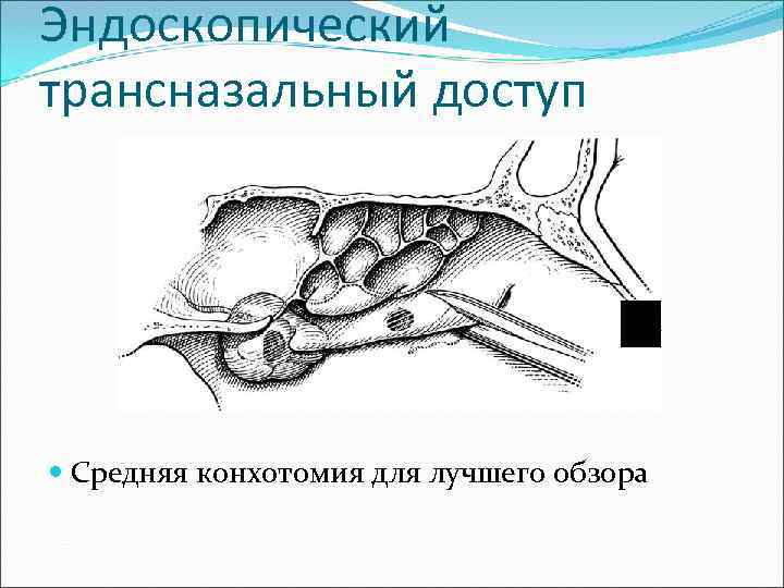 Эндоскопический трансназальный доступ  Средняя конхотомия для лучшего обзора 