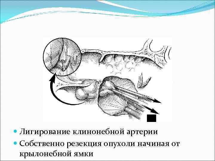  Лигирование клинонебной артерии  Собственно резекция опухоли начиная от  крылонебной ямки 