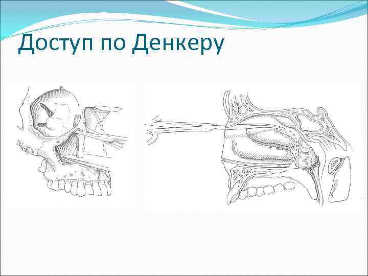 Доступ по Денкеру 