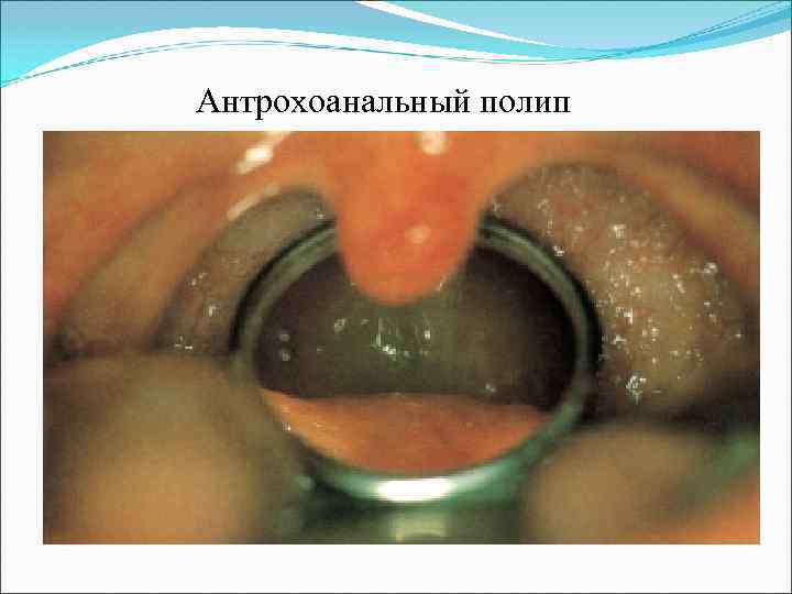 Антрохоанальный полип 