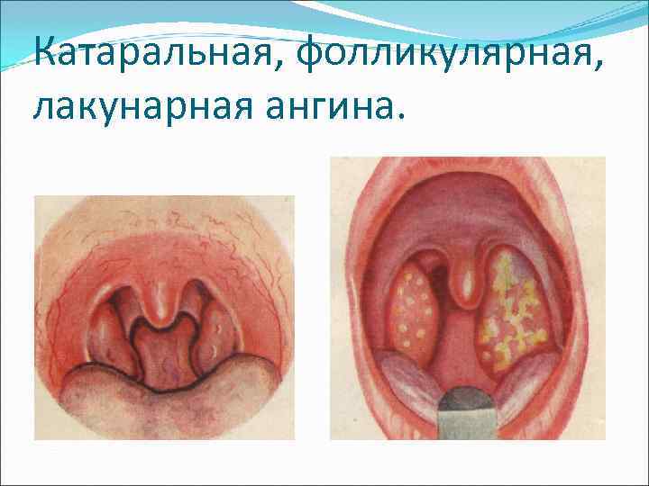 Катаральная, фолликулярная, лакунарная ангина. 