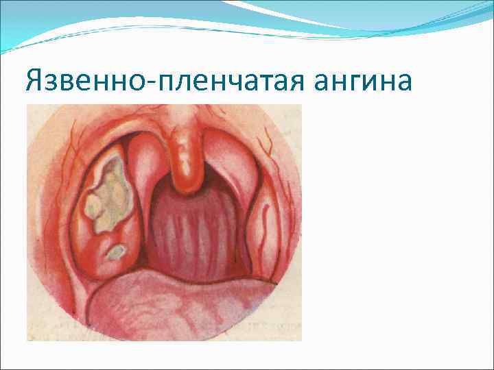 Язвенно-пленчатая ангина 
